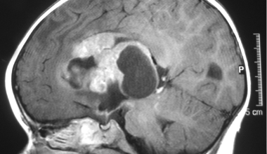 symptoms of brain tumors